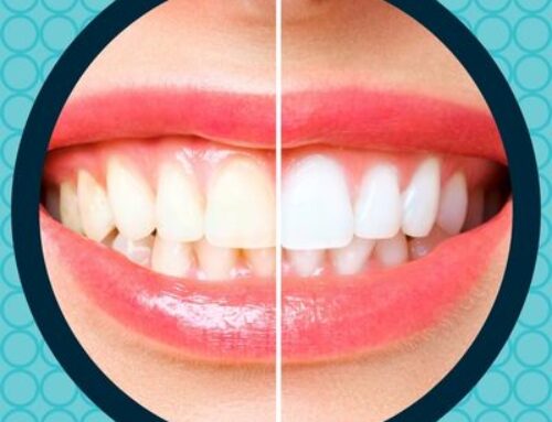 Teeth Whitening At Earwood Dentistry