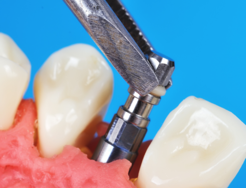 How Dental Implant Crowns Can Transform Your Smile