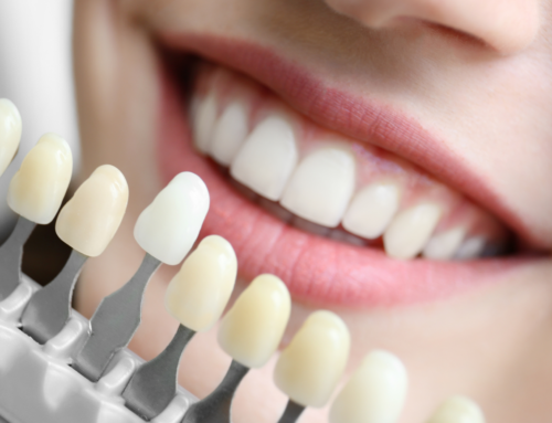 Transform Your Smile With Dental Veneers In Raleigh, NC